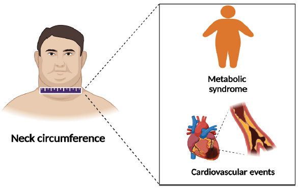 Correlación de la circunferencia del cuello, la gravedad de la calcificación coronaria y los eventos cardiovasculares en pacientes ancianos chinos con síndromes coronarios agudos